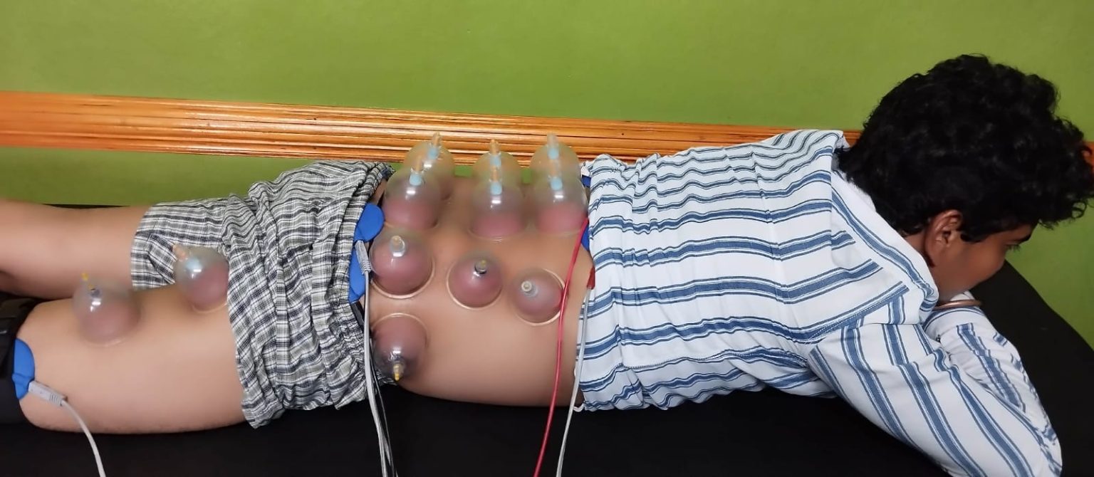 Cupping therapy low back pain