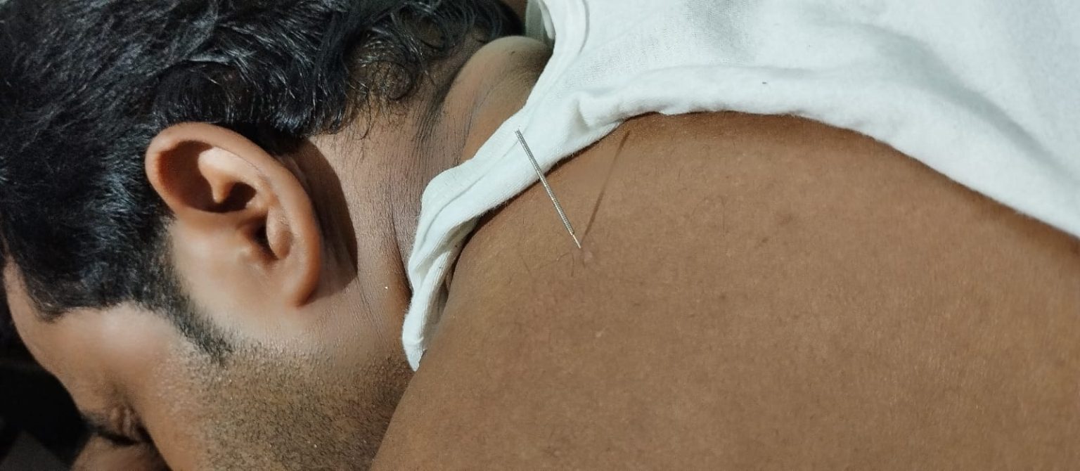 Dry needling